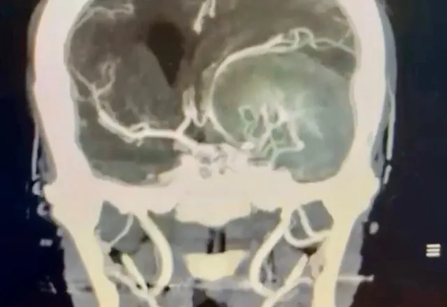 Angiotomografía de un tumor cerebral de base de cráneo evaluado por el Dr. Edgardo Mateo, neurocirugía oncológica en RD